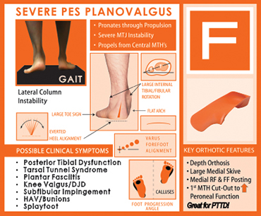 F Quad Foot Type