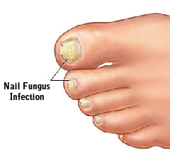 Fungal Nails